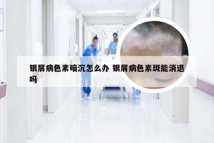 银屑病色素暗沉怎么办 银屑病色素斑能消退吗