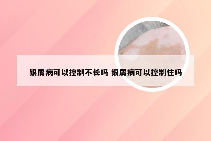 银屑病可以控制不长吗 银屑病可以控制住吗