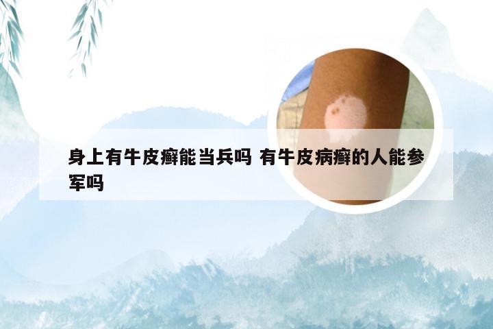 身上有牛皮癣能当兵吗 有牛皮病癣的人能参军吗