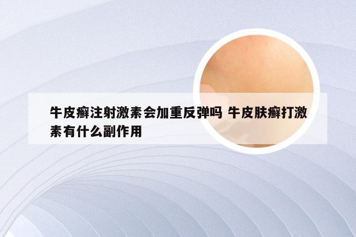 牛皮癣注射激素会加重反弹吗 牛皮肤癣打激素有什么副作用