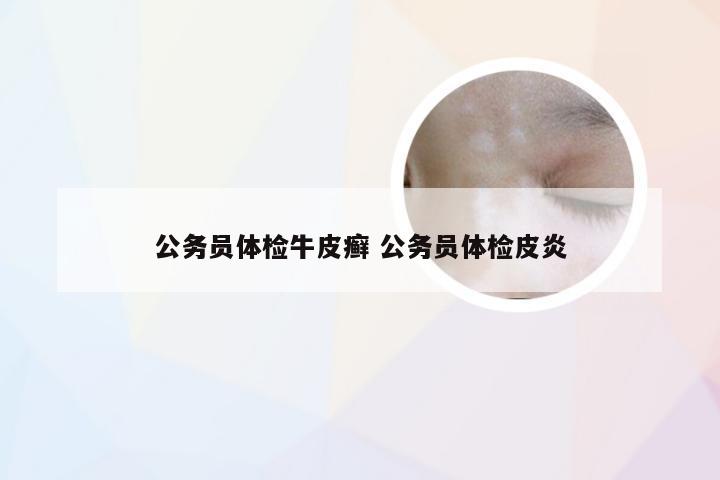 公务员体检牛皮癣 公务员体检皮炎