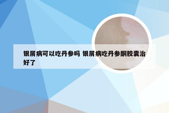 银屑病可以吃丹参吗 银屑病吃丹参酮胶囊治好了