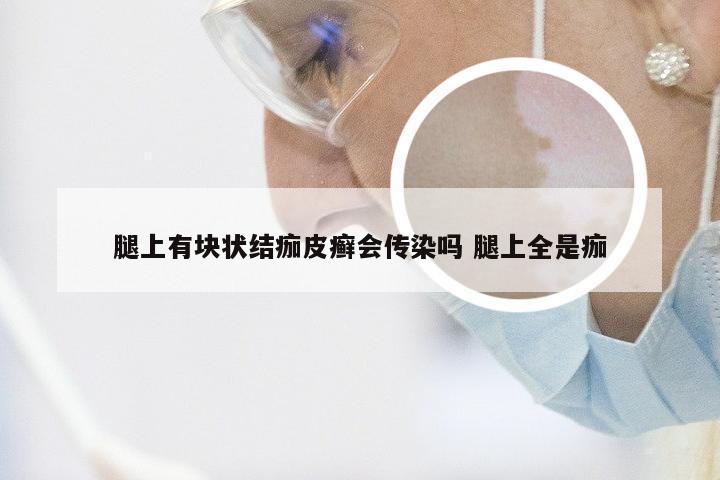 腿上有块状结痂皮癣会传染吗 腿上全是痂