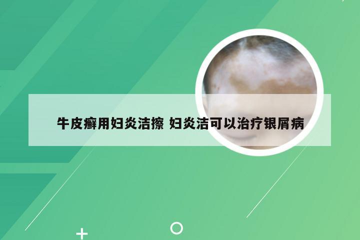 牛皮癣用妇炎洁擦 妇炎洁可以治疗银屑病