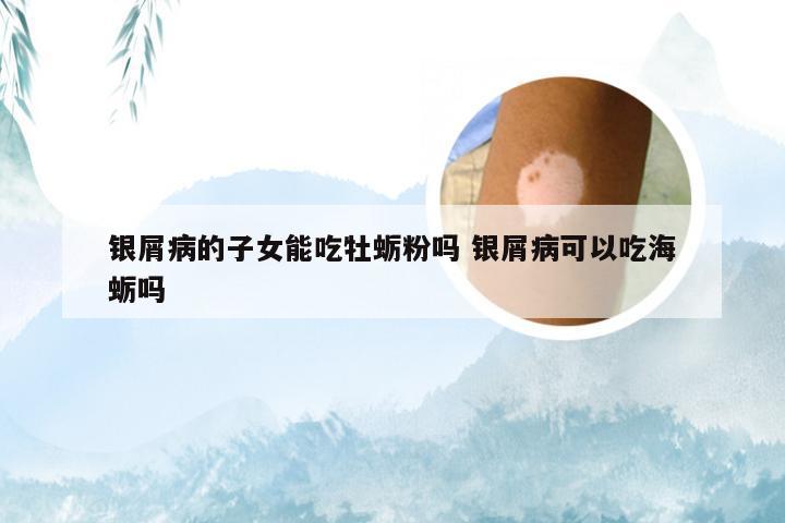 银屑病的子女能吃牡蛎粉吗 银屑病可以吃海蛎吗