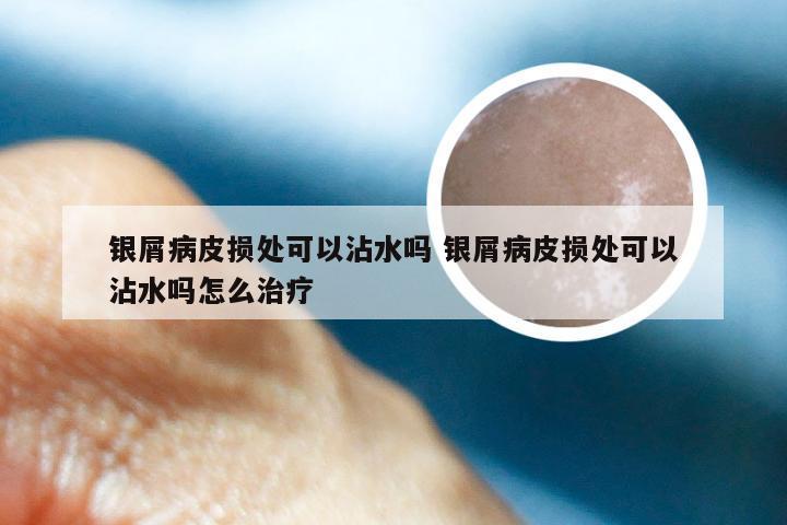 银屑病皮损处可以沾水吗 银屑病皮损处可以沾水吗怎么治疗