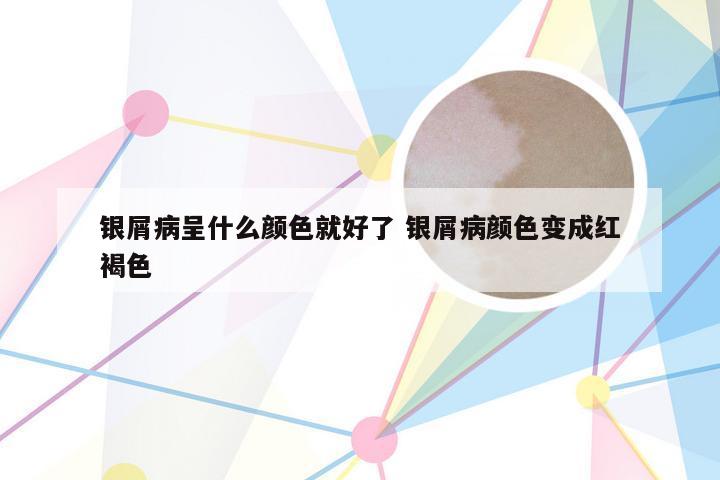 银屑病呈什么颜色就好了 银屑病颜色变成红褐色