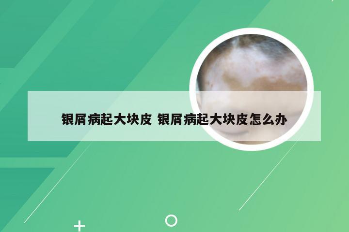 银屑病起大块皮 银屑病起大块皮怎么办