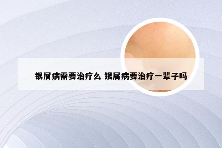 银屑病需要治疗么 银屑病要治疗一辈子吗