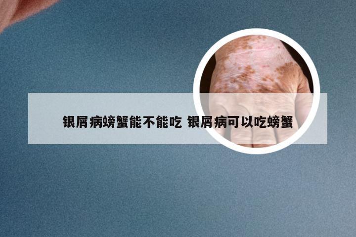 银屑病螃蟹能不能吃 银屑病可以吃螃蟹