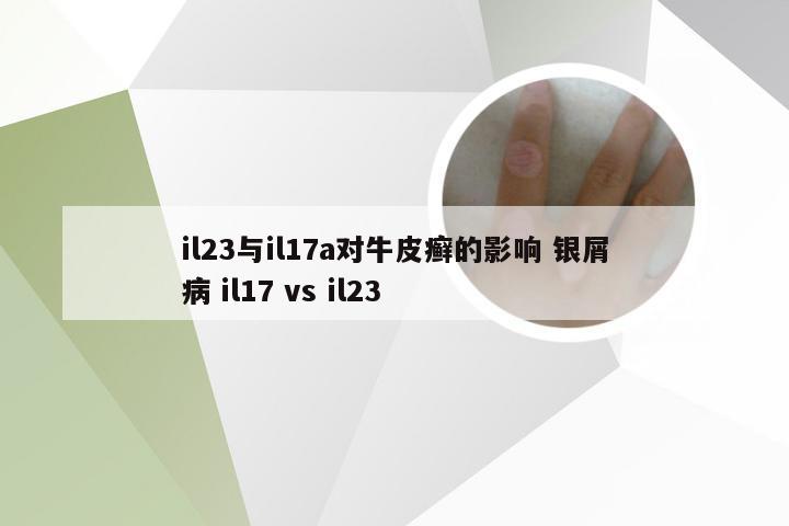 il23与il17a对牛皮癣的影响 银屑病 il17 vs il23