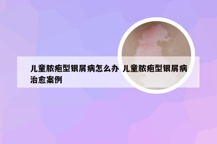 儿童脓疱型银屑病怎么办 儿童脓疱型银屑病治愈案例