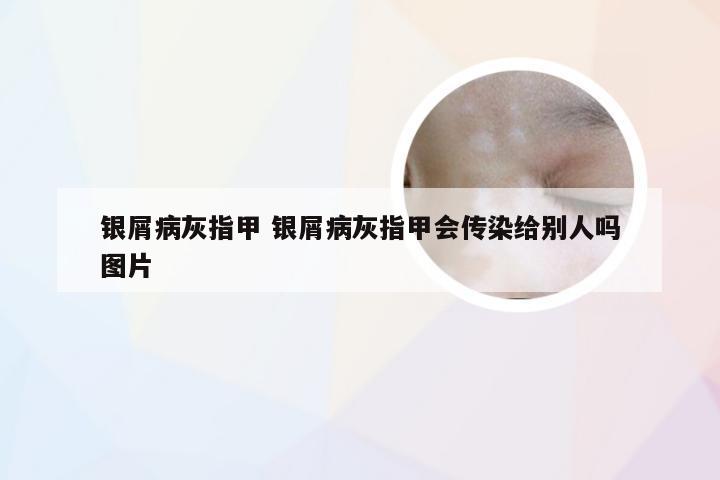 银屑病灰指甲 银屑病灰指甲会传染给别人吗图片