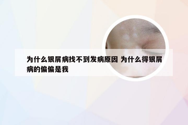 为什么银屑病找不到发病原因 为什么得银屑病的偏偏是我