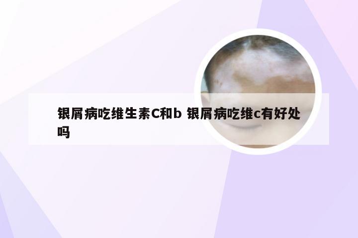 银屑病吃维生素C和b 银屑病吃维c有好处吗