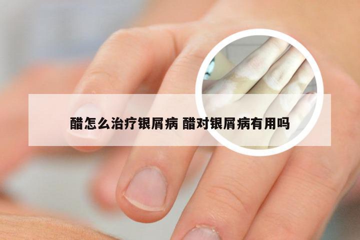 醋怎么治疗银屑病 醋对银屑病有用吗