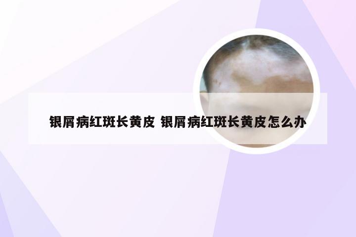 银屑病红斑长黄皮 银屑病红斑长黄皮怎么办