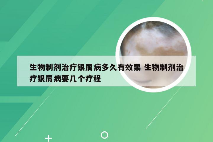 生物制剂治疗银屑病多久有效果 生物制剂治疗银屑病要几个疗程