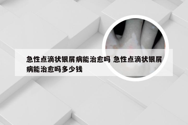 急性点滴状银屑病能治愈吗 急性点滴状银屑病能治愈吗多少钱