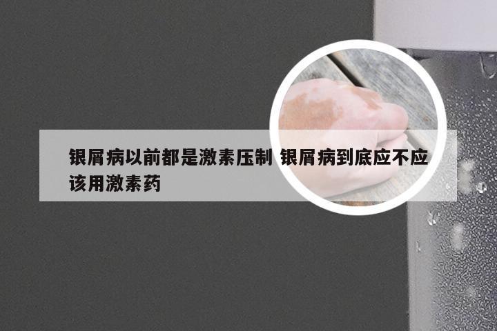 银屑病以前都是激素压制 银屑病到底应不应该用激素药