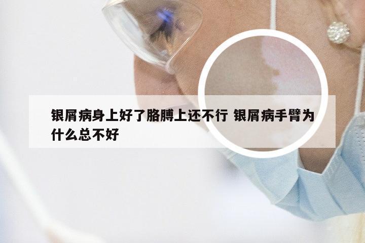 银屑病身上好了胳膊上还不行 银屑病手臂为什么总不好