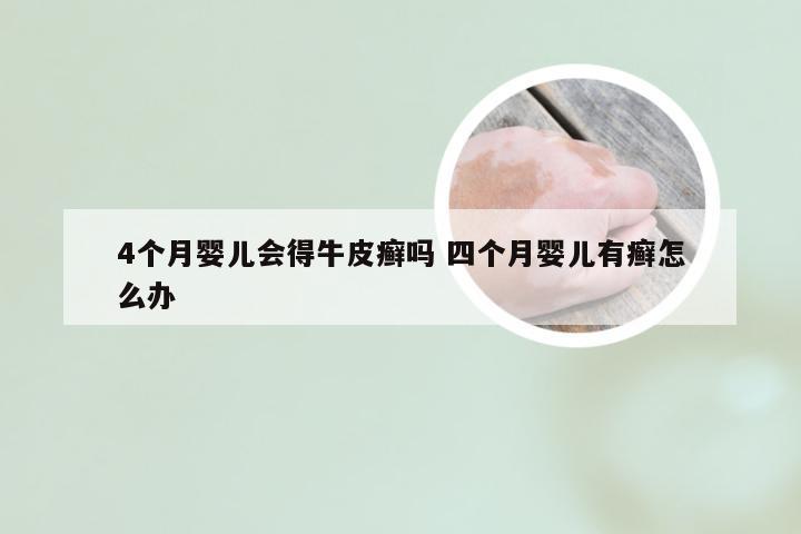 4个月婴儿会得牛皮癣吗 四个月婴儿有癣怎么办