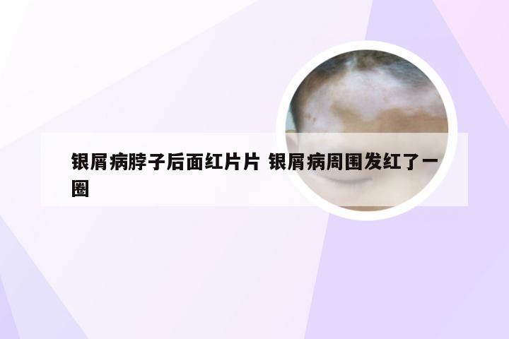 银屑病脖子后面红片片 银屑病周围发红了一圈