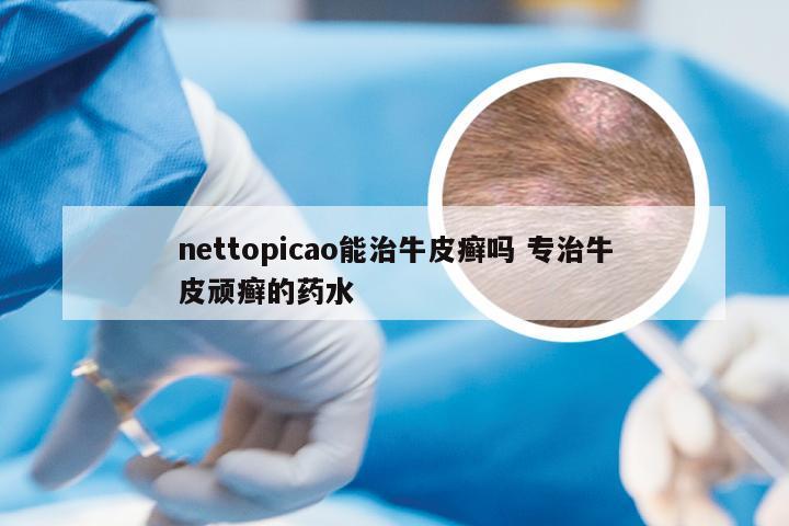 nettopicao能治牛皮癣吗 专治牛皮顽癣的药水