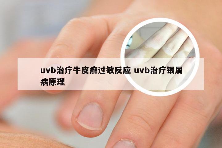 uvb治疗牛皮癣过敏反应 uvb治疗银屑病原理