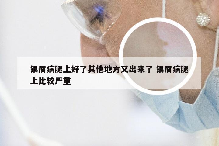 银屑病腿上好了其他地方又出来了 银屑病腿上比较严重