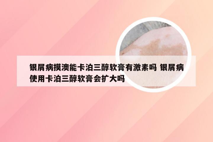 银屑病摸澳能卡泊三醇软膏有激素吗 银屑病使用卡泊三醇软膏会扩大吗