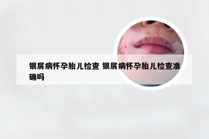 银屑病怀孕胎儿检查 银屑病怀孕胎儿检查准确吗