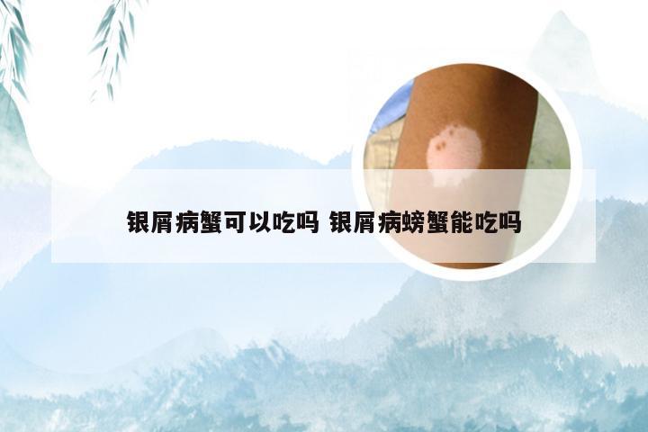 银屑病蟹可以吃吗 银屑病螃蟹能吃吗