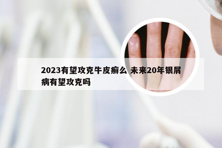 2023有望攻克牛皮癣么 未来20年银屑病有望攻克吗