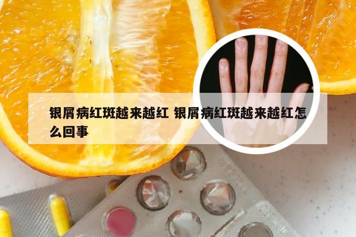 银屑病红斑越来越红 银屑病红斑越来越红怎么回事