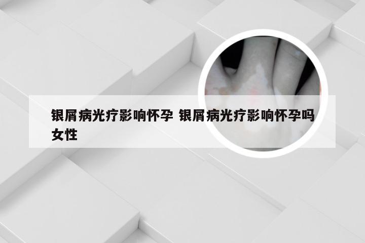 银屑病光疗影响怀孕 银屑病光疗影响怀孕吗女性