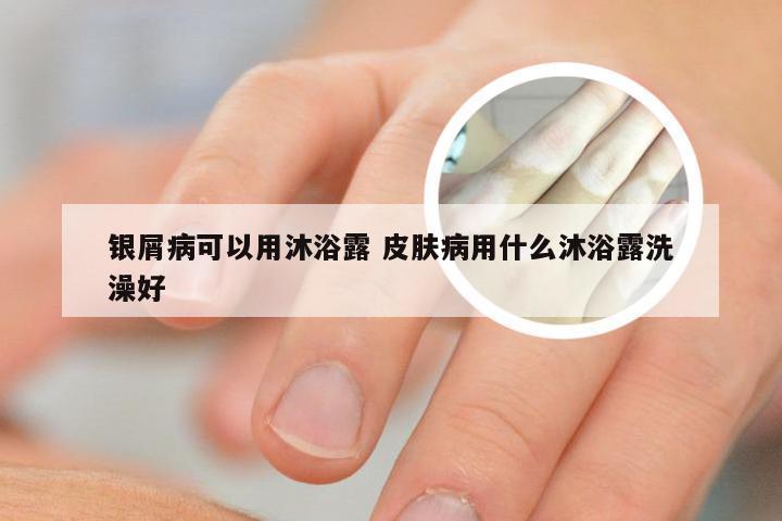 银屑病可以用沐浴露 皮肤病用什么沐浴露洗澡好