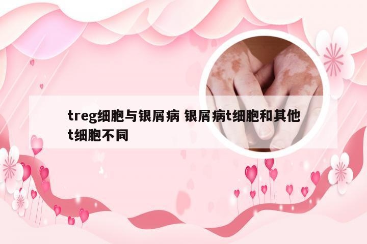 treg细胞与银屑病 银屑病t细胞和其他t细胞不同