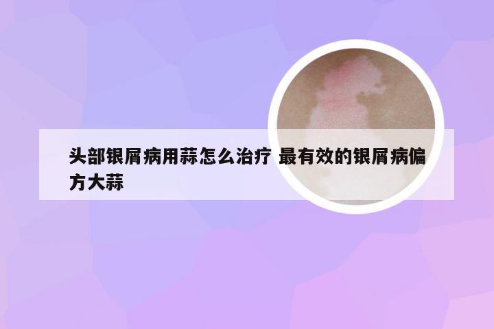 头部银屑病用蒜怎么治疗 最有效的银屑病偏方大蒜