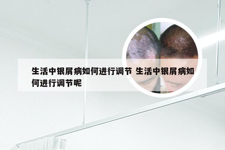 生活中银屑病如何进行调节 生活中银屑病如何进行调节呢