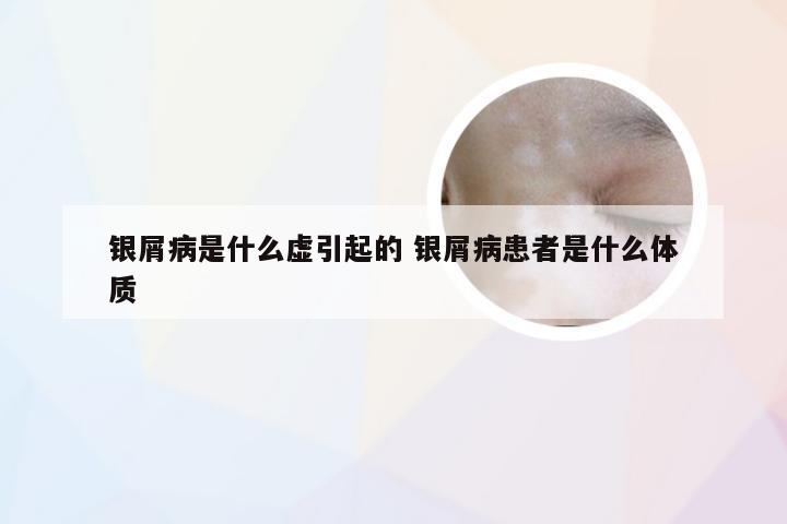 银屑病是什么虚引起的 银屑病患者是什么体质