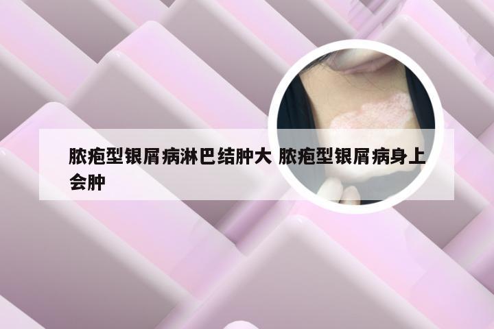 脓疱型银屑病淋巴结肿大 脓疱型银屑病身上会肿