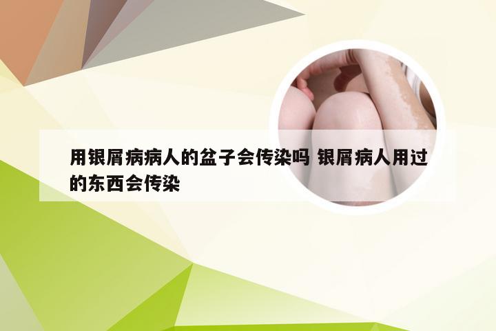 用银屑病病人的盆子会传染吗 银屑病人用过的东西会传染