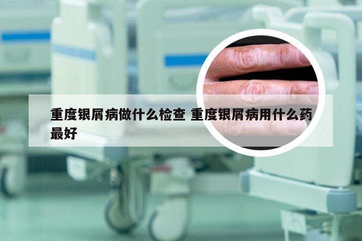 重度银屑病做什么检查 重度银屑病用什么药最好