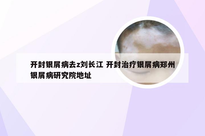 开封银屑病去z刘长江 开封治疗银屑病郑州银屑病研究院地址