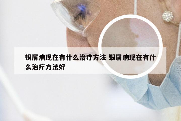 银屑病现在有什么治疗方法 银屑病现在有什么治疗方法好