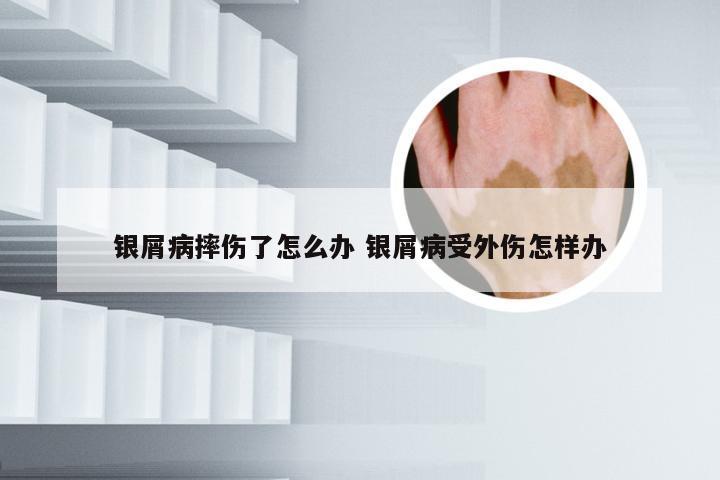 银屑病摔伤了怎么办 银屑病受外伤怎样办