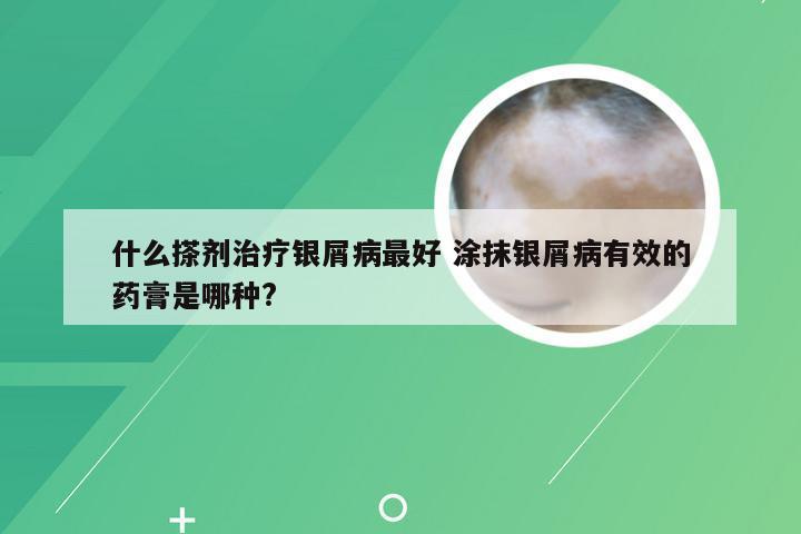 什么搽剂治疗银屑病最好 涂抹银屑病有效的药膏是哪种?