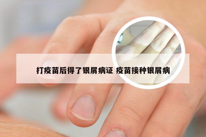 打疫苗后得了银屑病证 疫苗接种银屑病