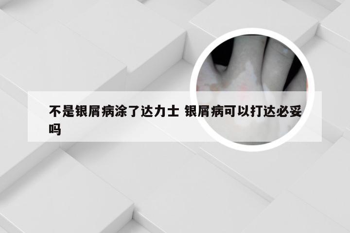 不是银屑病涂了达力士 银屑病可以打达必妥吗